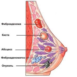 КРЕМ для лечения и профилактики мастопатии "МАСТОКРЕЛЬ", основные показания к применению